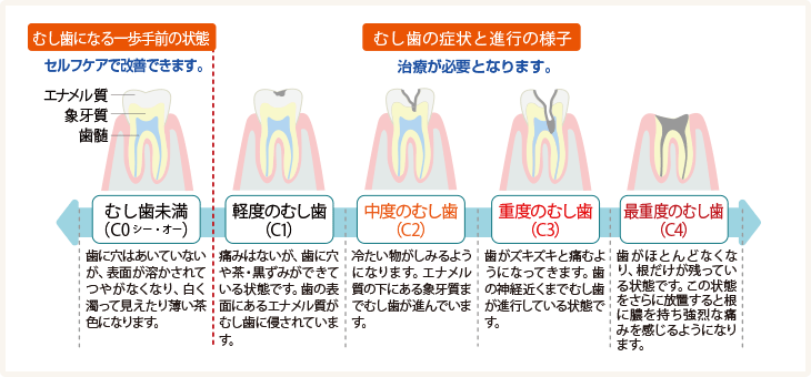 虫歯の進行図