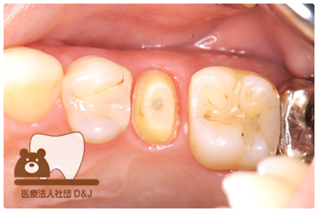フルジルコニアクラウン治療前の写真