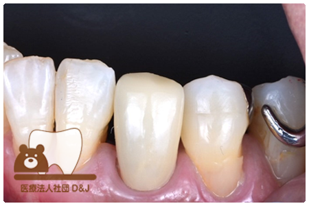 E-maxクラウン　左下3