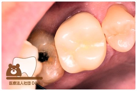 フリジルコニアクラウン　左上6