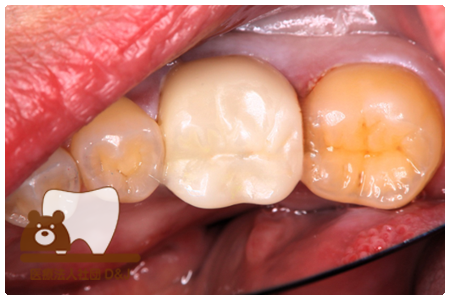 フルジルコニアクラウン　左下6