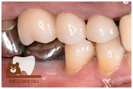 症例1インプラント治療後の写真