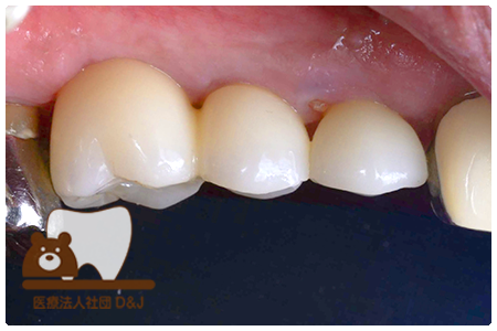 症例1インプラント治療後の写真