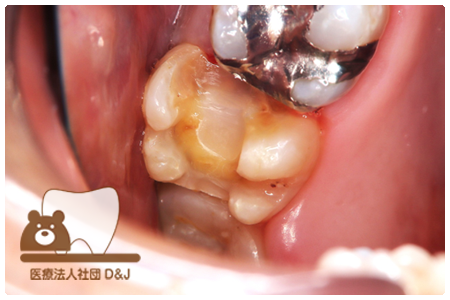 症例8プレスセラミックインレー治療前の写真