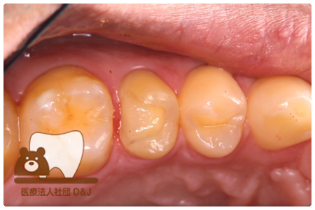 症例9オールセラミックインレー治療前の写真