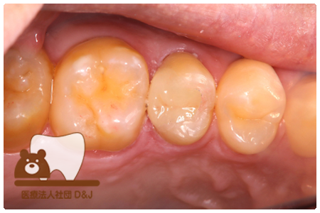 症例9オールセラミックインレー治療後の写真