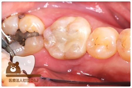 プレスセラミックインレー治療後の写真