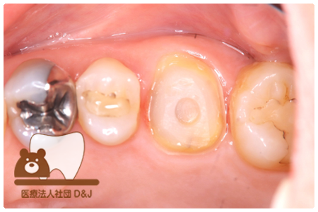 フルジルコニアクラウン　右上6