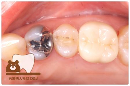 フルジルコニアクラウン　右上6