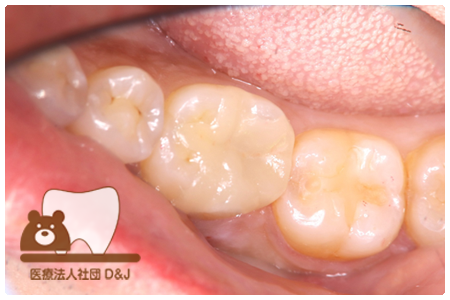 オールセラミックインレー　右下6