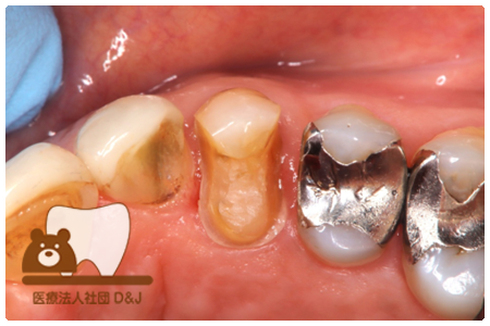プレスセラミックインレー 右上4