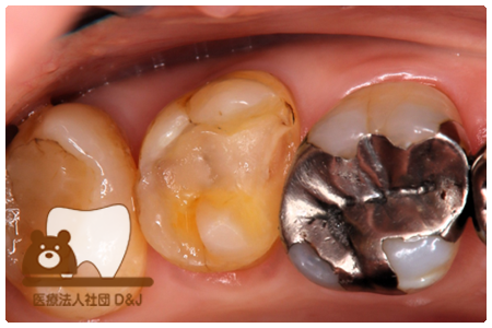 プレスセラミックインレー　左上7