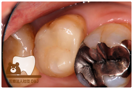 プレスセラミックインレー　左上7