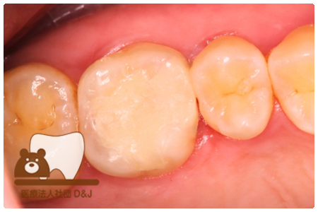 プレスセラミックインレー　左上６