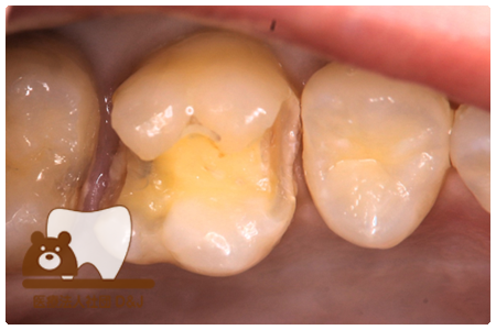 プレスセラミックインレー　左上6