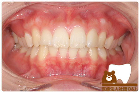 症例1オフィスホワイトニング治療前の写真